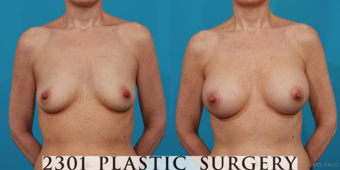 Before & After Breast Augmentation Case 314 View #1 View in Fort Worth, Plano, & Frisco, Texas