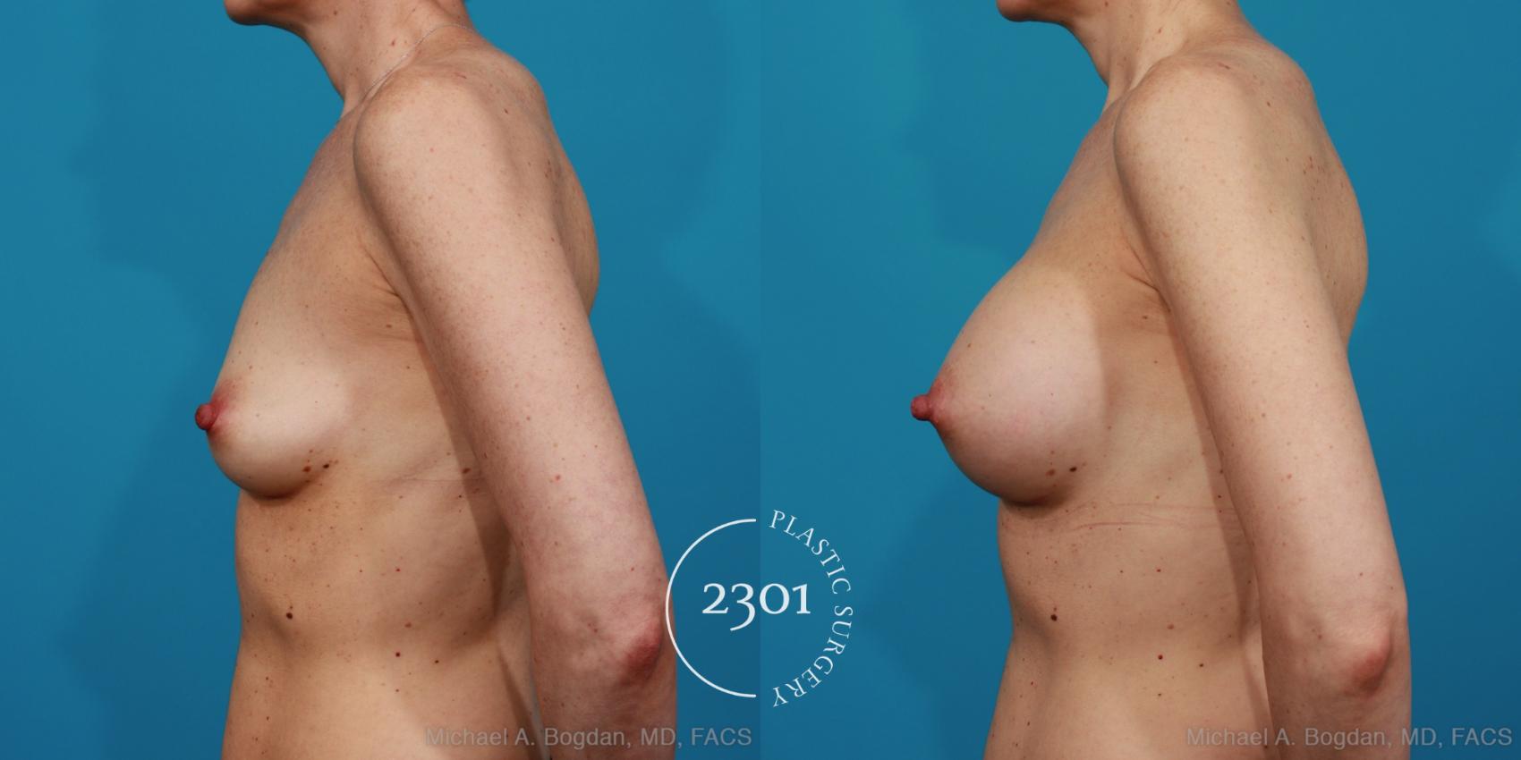 Before & After Silicone Implants Case 314 View #2 View in Fort Worth, Plano, & Frisco, Texas