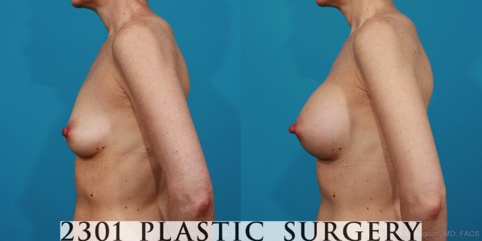 Before & After Silicone Implants Case 314 View #2 View in Fort Worth, Plano, & Frisco, Texas