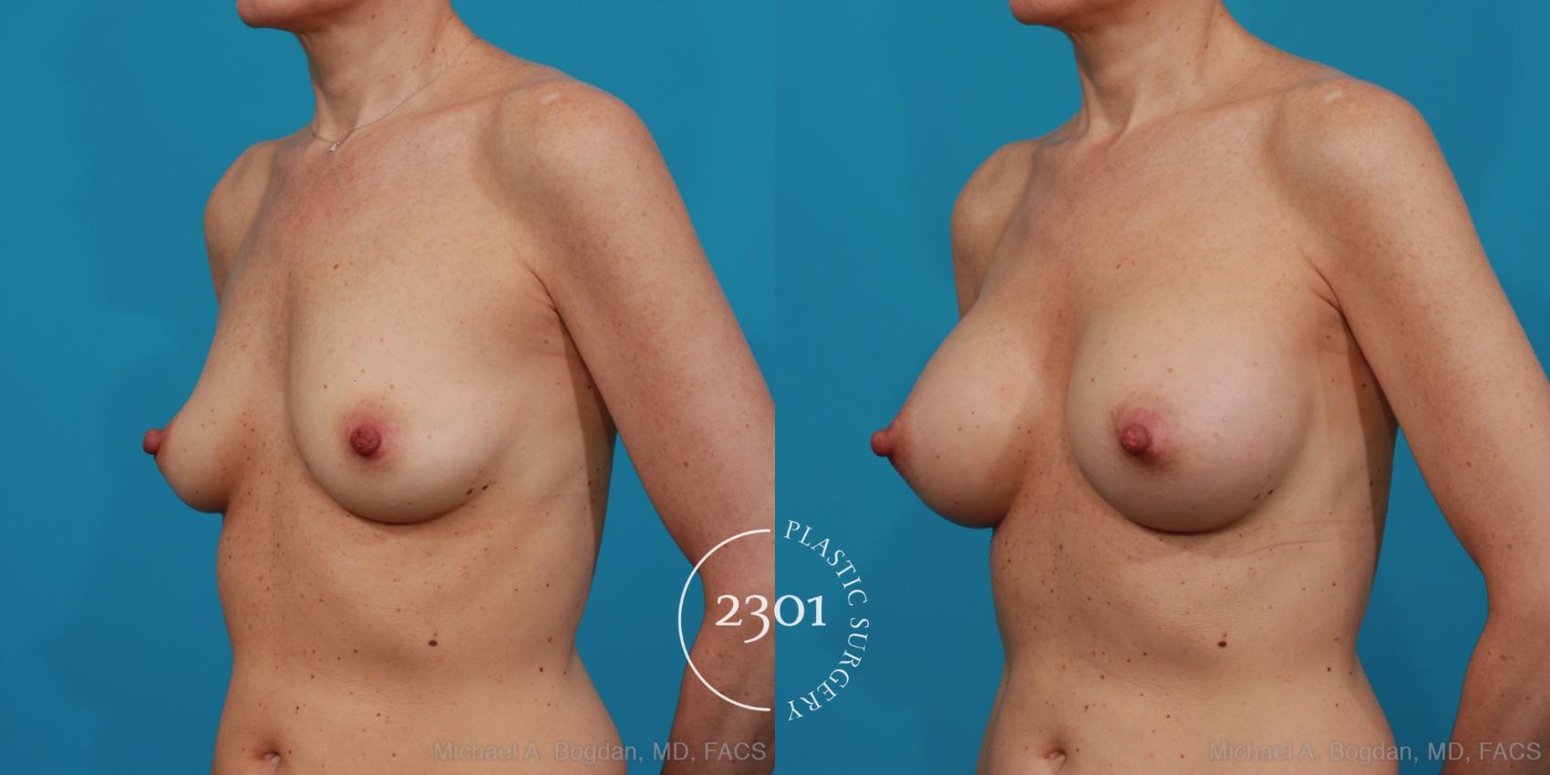 Before & After Silicone Implants Case 314 View #3 View in Fort Worth, Plano, & Frisco, Texas