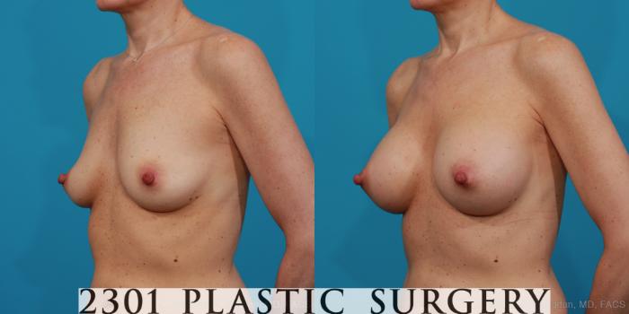 Before & After Silicone Implants Case 314 View #3 View in Fort Worth, Plano, & Frisco, Texas
