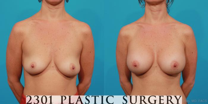 Before & After Silicone Implants Case 315 View #1 View in Fort Worth, Plano, & Frisco, Texas