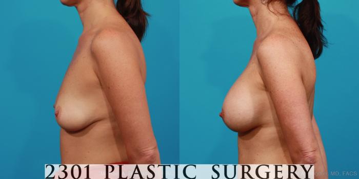 Before & After Silicone Implants Case 315 View #2 View in Fort Worth, Plano, & Frisco, Texas