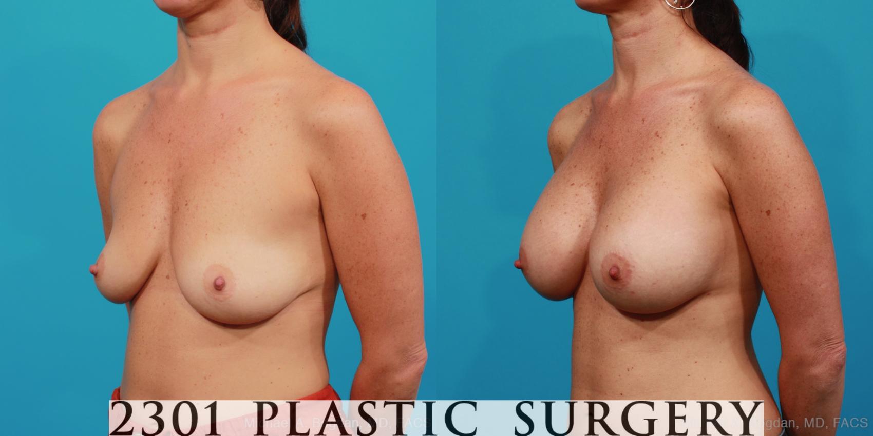 Before & After Silicone Implants Case 315 View #3 View in Fort Worth & Frisco, Texas