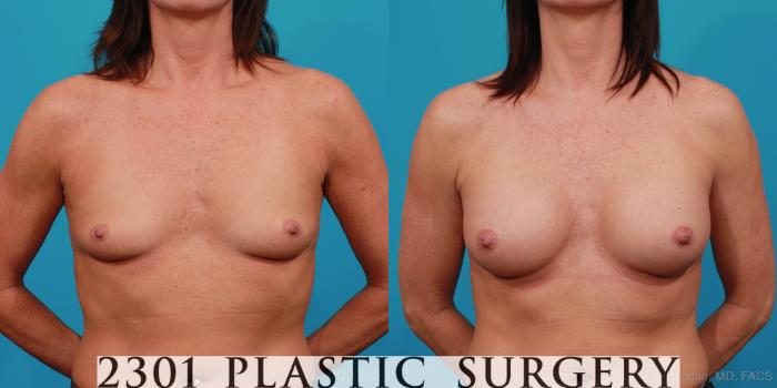 Before & After Silicone Implants Case 322 View #1 View in Fort Worth, Plano, & Frisco, Texas
