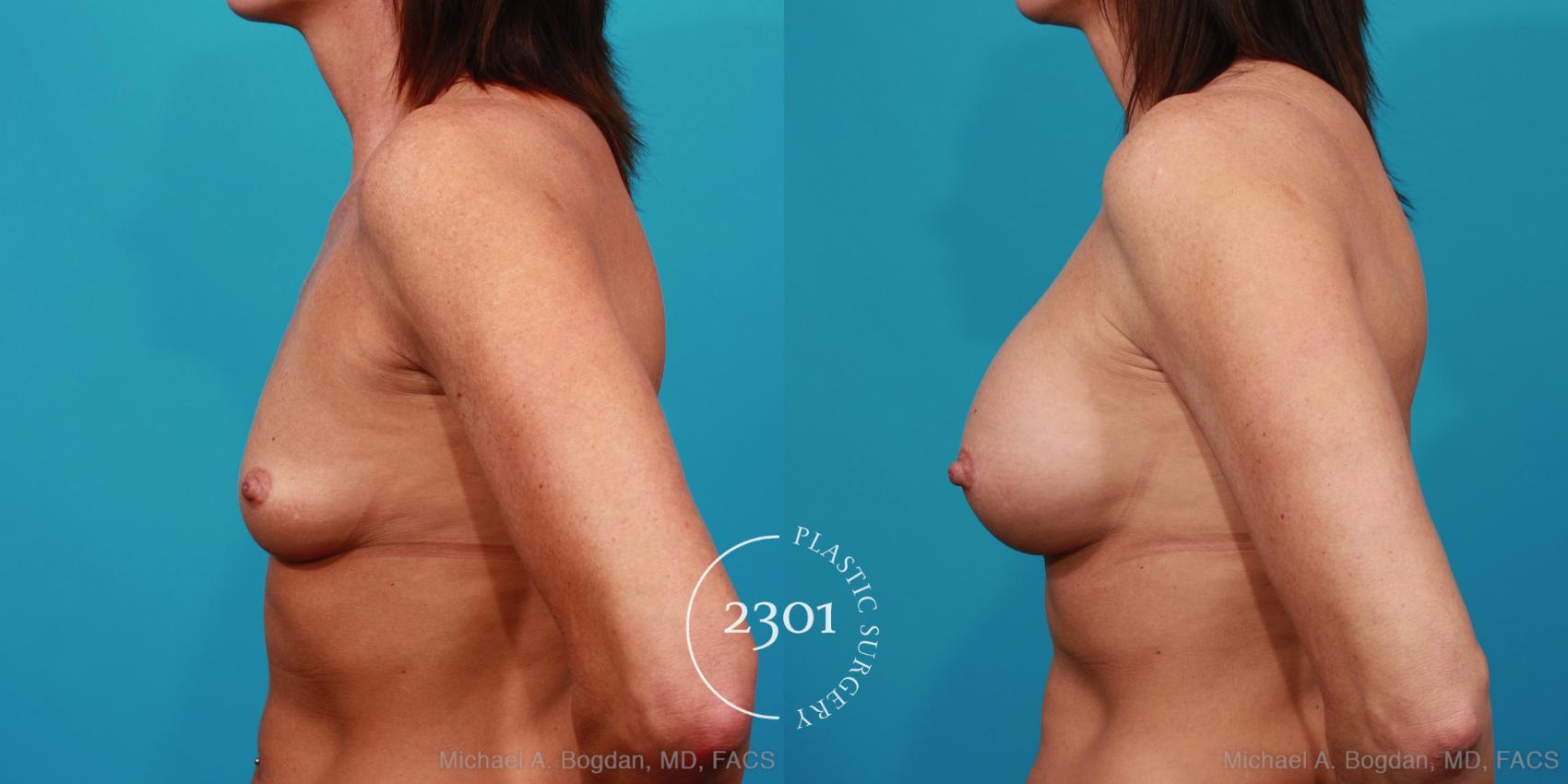 Before & After Silicone Implants Case 322 View #2 View in Fort Worth, Plano, & Frisco, Texas