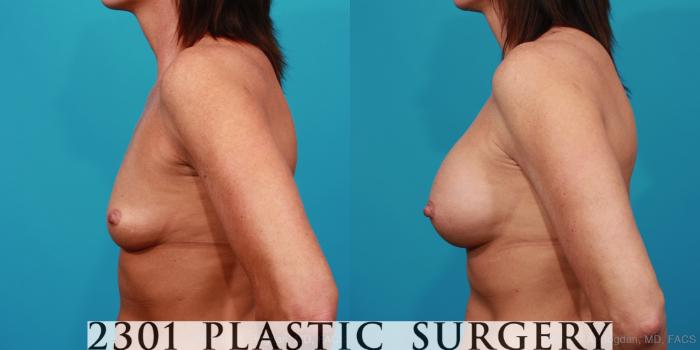 Before & After Silicone Implants Case 322 View #2 View in Fort Worth, Plano, & Frisco, Texas