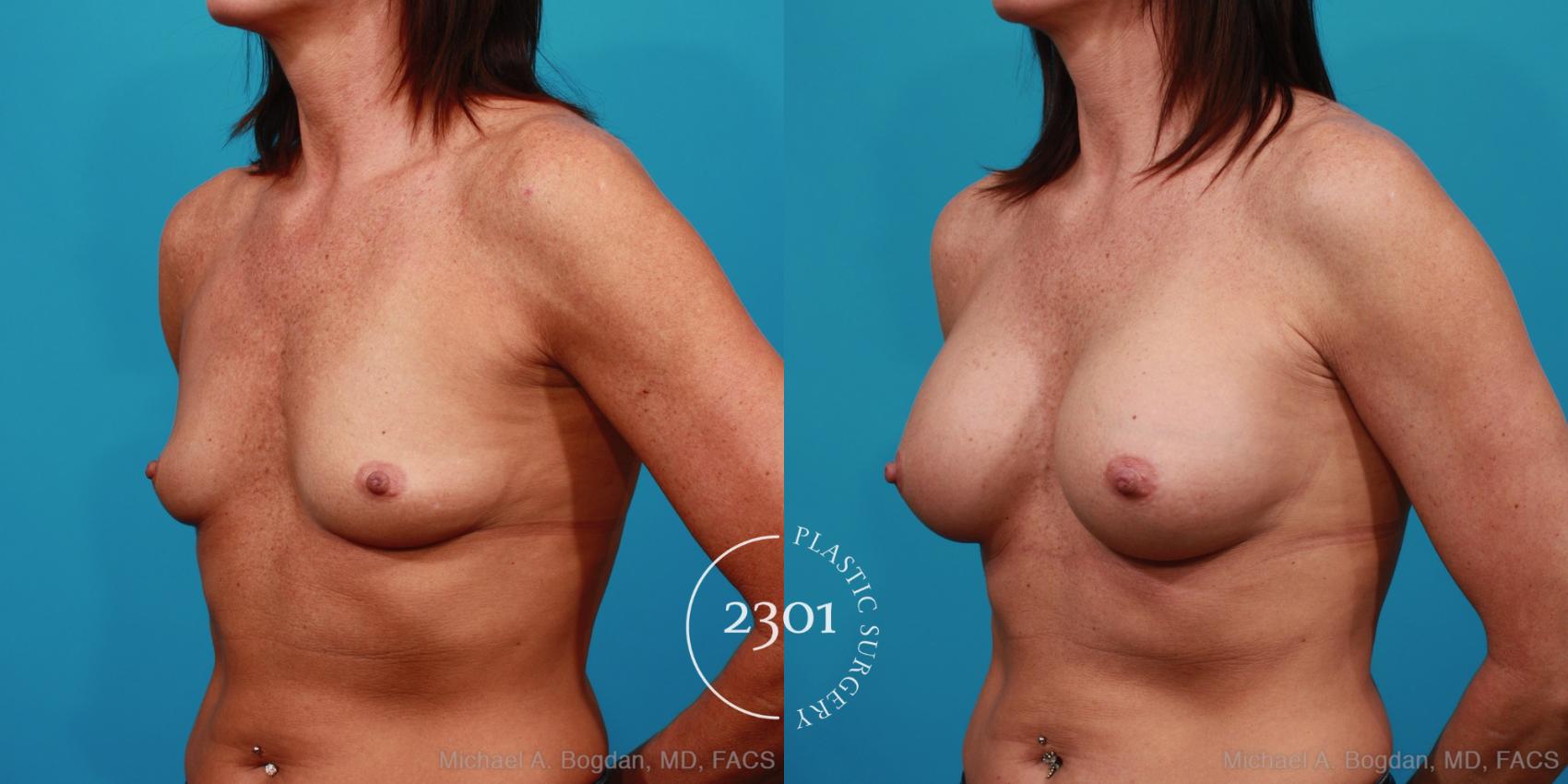 Before & After Silicone Implants Case 322 View #3 View in Fort Worth, Plano, & Frisco, Texas