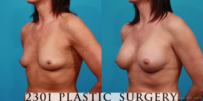 Before & After Silicone Implants Case 322 View #3 View in Fort Worth, Plano, & Frisco, Texas