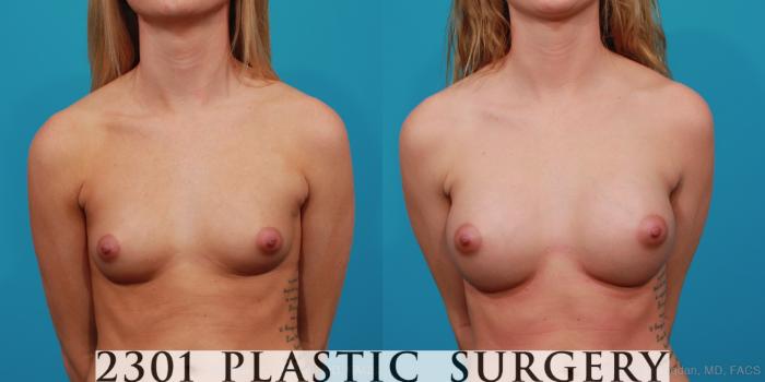 Before & After Silicone Implants Case 324 View #1 View in Fort Worth, Plano, & Frisco, Texas