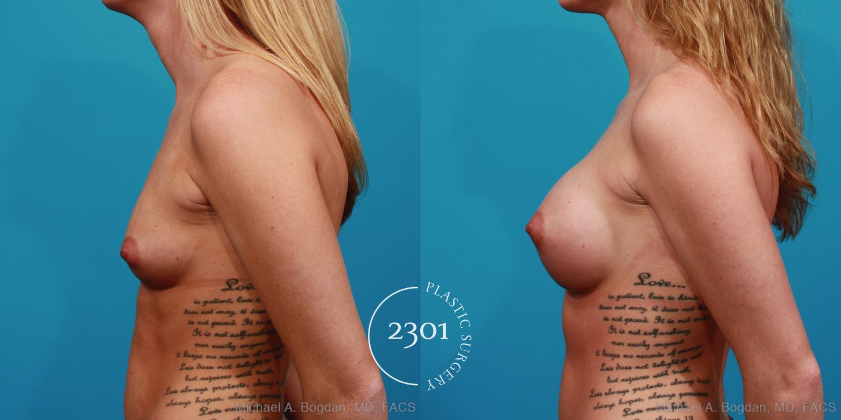 Before & After Silicone Implants Case 324 View #2 View in Fort Worth, Plano, & Frisco, Texas