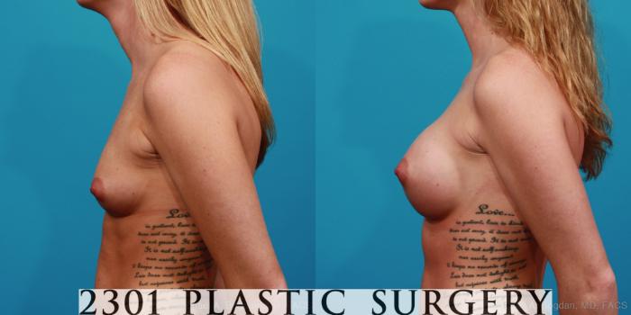 Before & After Silicone Implants Case 324 View #2 View in Fort Worth, Plano, & Frisco, Texas
