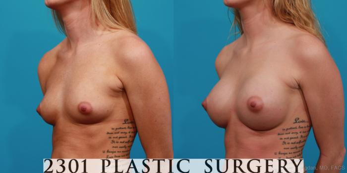 Before & After Silicone Implants Case 324 View #3 View in Fort Worth, Plano, & Frisco, Texas