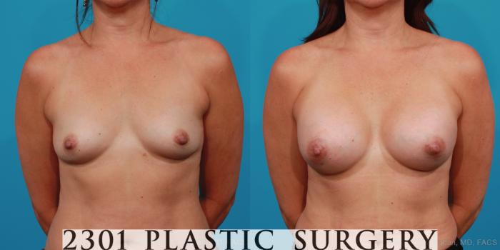 Before & After Silicone Implants Case 325 View #1 View in Fort Worth, Plano, & Frisco, Texas