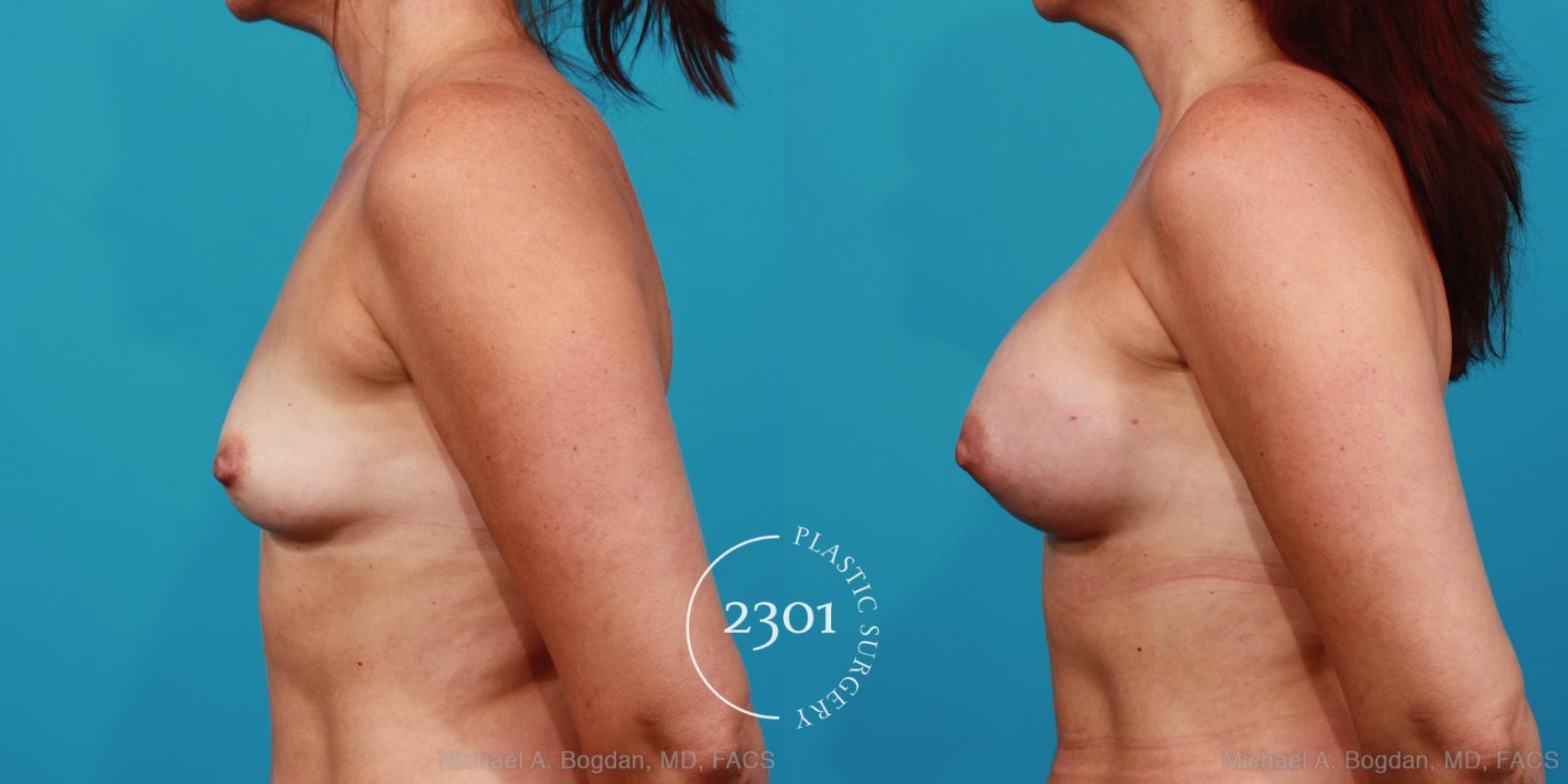 Before & After Silicone Implants Case 325 View #2 View in Fort Worth, Plano, & Frisco, Texas