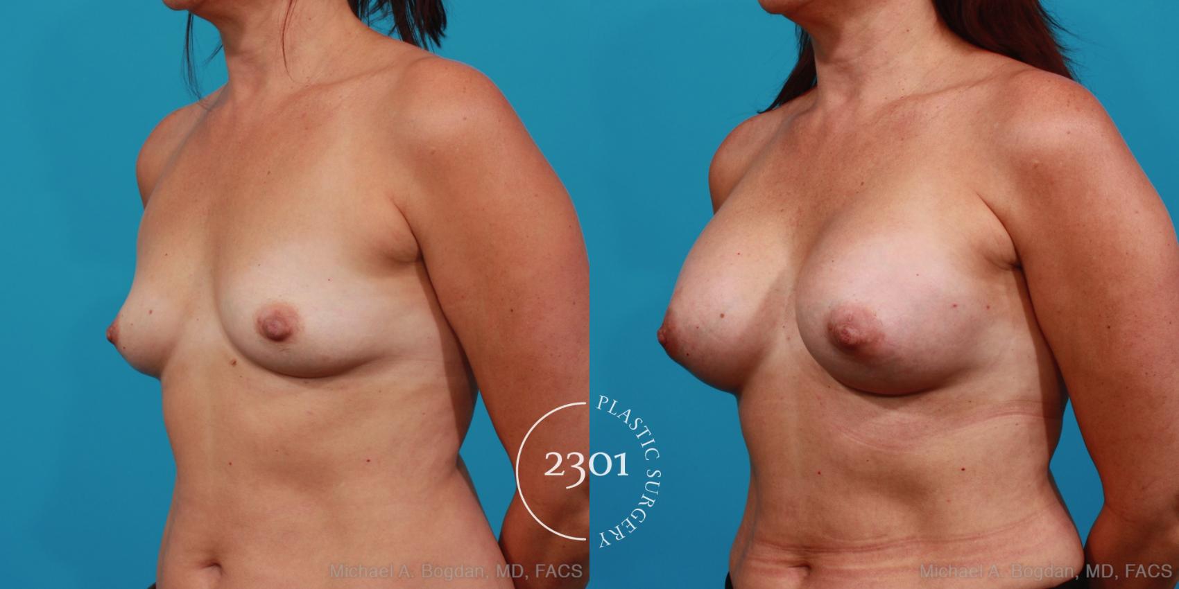 Before & After Silicone Implants Case 325 View #3 View in Fort Worth, Plano, & Frisco, Texas