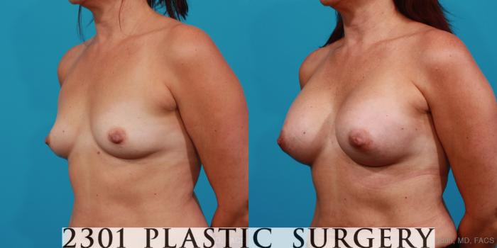 Before & After Silicone Implants Case 325 View #3 View in Fort Worth, Plano, & Frisco, Texas