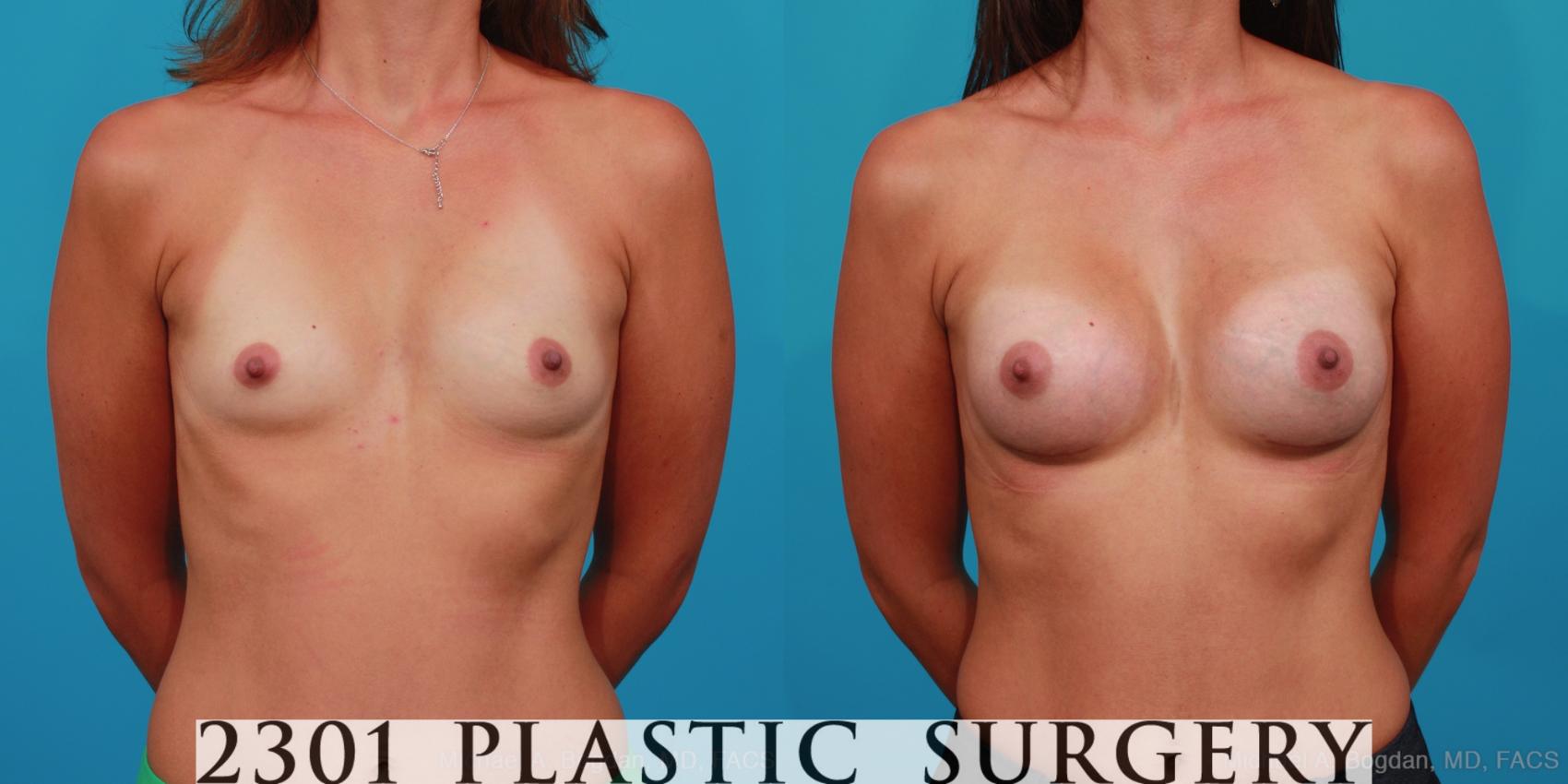 Before & After Silicone Implants Case 328 View #1 View in Fort Worth & Frisco, Texas
