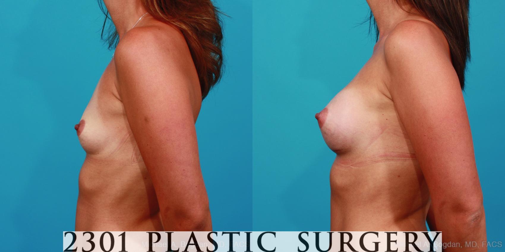 Before & After Silicone Implants Case 328 View #2 View in Fort Worth & Frisco, Texas