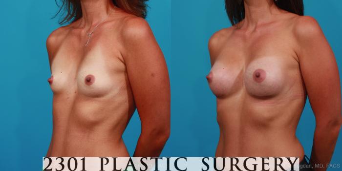 Before & After Breast Augmentation Case 328 View #3 View in Fort Worth, Plano, & Frisco, Texas