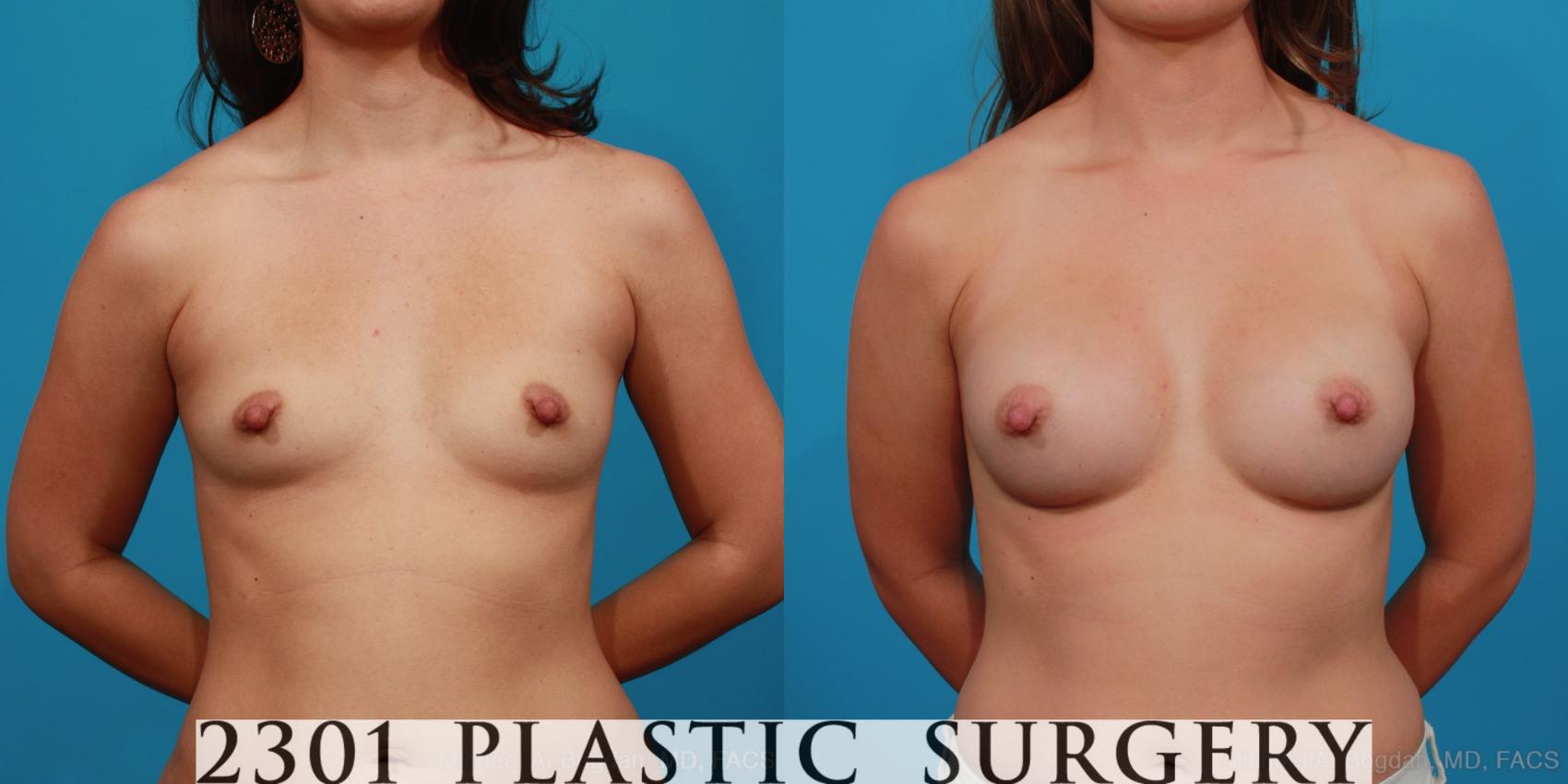 Before & After Silicone Implants Case 329 View #1 View in Fort Worth, Plano, & Frisco, Texas