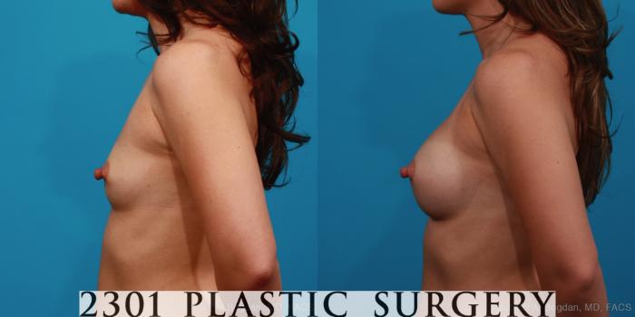 Before & After Silicone Implants Case 329 View #2 View in Fort Worth, Plano, & Frisco, Texas