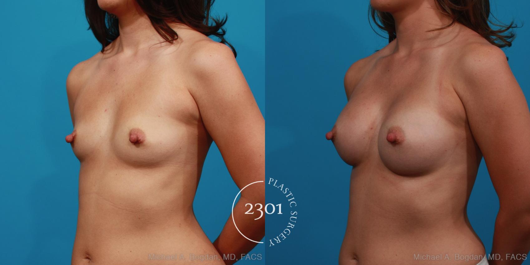 Before & After Silicone Implants Case 329 View #3 View in Fort Worth, Plano, & Frisco, Texas