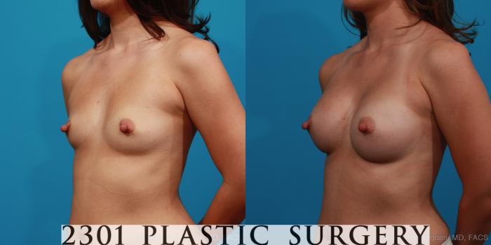 Before & After Silicone Implants Case 329 View #3 View in Fort Worth, Plano, & Frisco, Texas