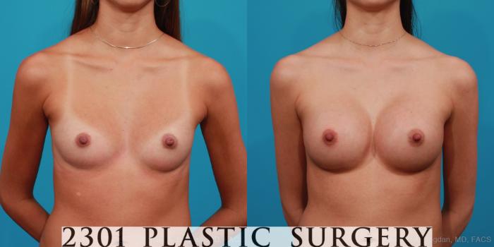 Before & After Silicone Implants Case 332 View #1 View in Fort Worth, Plano, & Frisco, Texas
