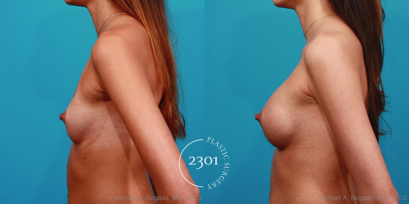 Before & After Silicone Implants Case 332 View #2 View in Fort Worth, Plano, & Frisco, Texas