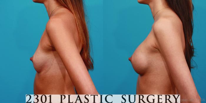 Before & After Silicone Implants Case 332 View #2 View in Fort Worth, Plano, & Frisco, Texas