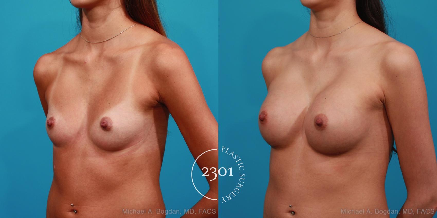 Before & After Silicone Implants Case 332 View #3 View in Fort Worth, Plano, & Frisco, Texas