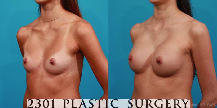 Before & After Silicone Implants Case 332 View #3 View in Fort Worth, Plano, & Frisco, Texas