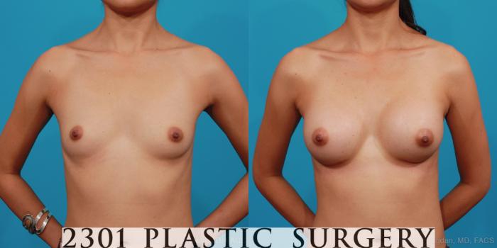 Before & After Silicone Implants Case 334 View #1 View in Fort Worth, Plano, & Frisco, Texas