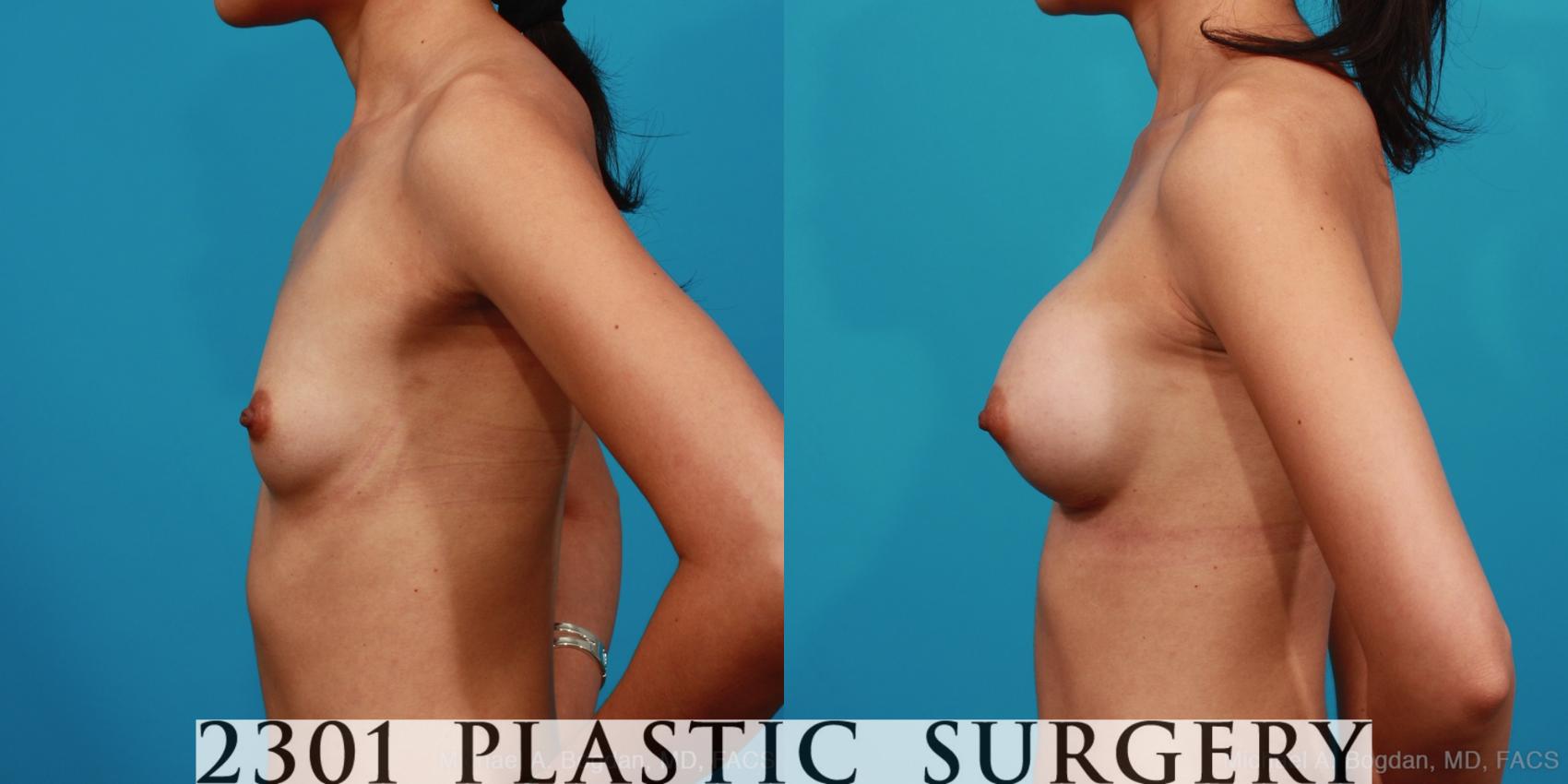 Before & After Silicone Implants Case 334 View #2 View in Fort Worth & Frisco, Texas