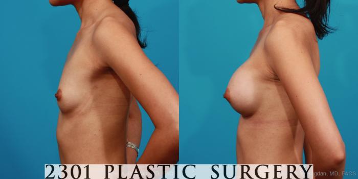 Before & After Silicone Implants Case 334 View #2 View in Fort Worth, Plano, & Frisco, Texas