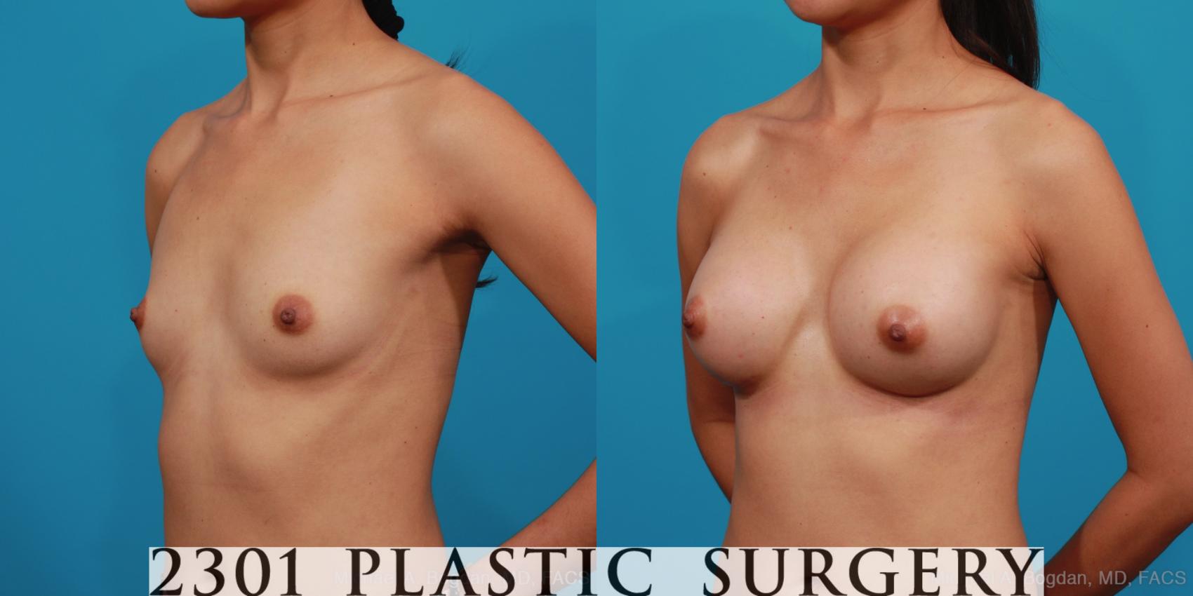 Before & After Silicone Implants Case 334 View #3 View in Fort Worth & Frisco, Texas