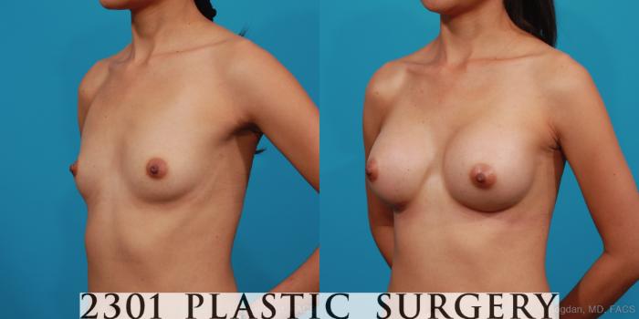 Before & After Silicone Implants Case 334 View #3 View in Fort Worth, Plano, & Frisco, Texas