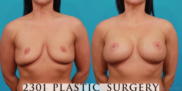 Before & After Silicone Implants Case 336 View #1 View in Fort Worth, Plano, & Frisco, Texas