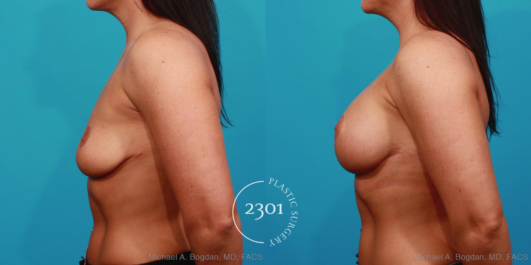 Before & After Silicone Implants Case 336 View #2 View in Fort Worth, Plano, & Frisco, Texas
