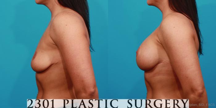Before & After Silicone Implants Case 336 View #2 View in Fort Worth, Plano, & Frisco, Texas