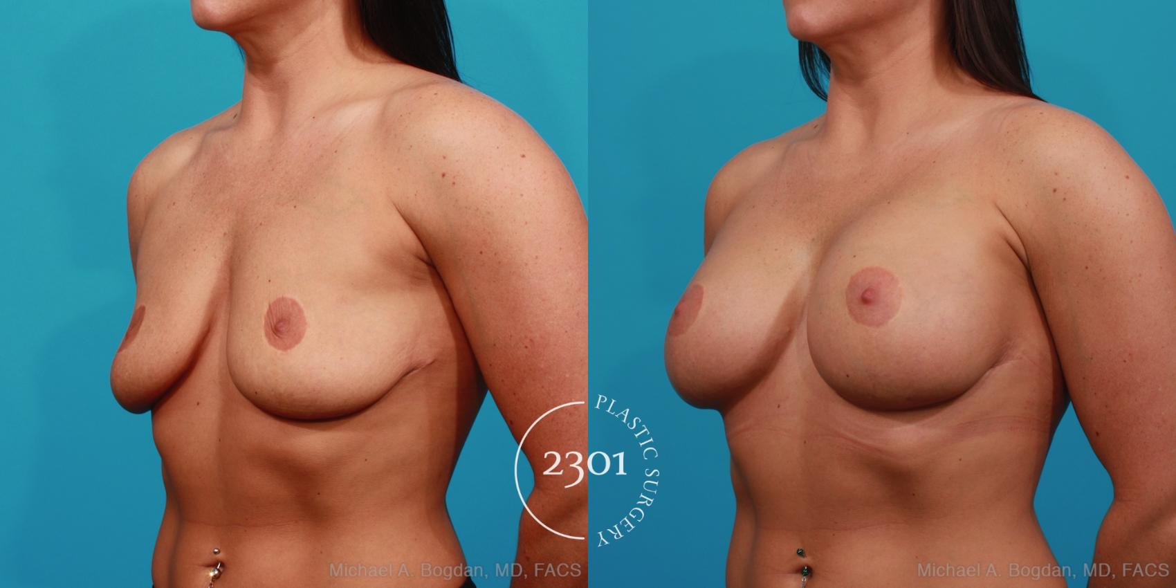 Before & After Silicone Implants Case 336 View #3 View in Fort Worth, Plano, & Frisco, Texas