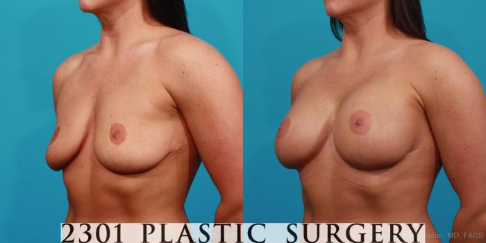 Before & After Silicone Implants Case 336 View #3 View in Fort Worth, Plano, & Frisco, Texas