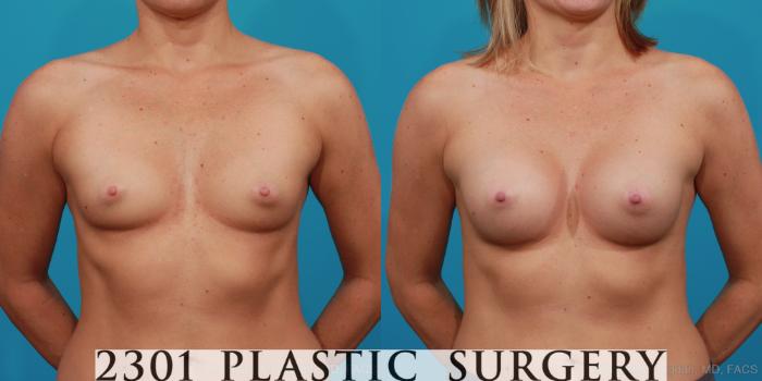 Before & After Silicone Implants Case 344 View #1 View in Fort Worth, Plano, & Frisco, Texas