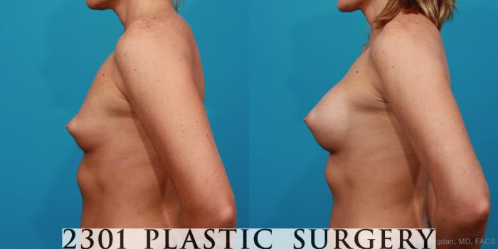 Before & After Silicone Implants Case 344 View #2 View in Fort Worth, Plano, & Frisco, Texas
