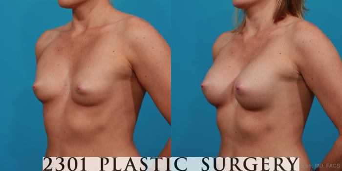 Before & After Silicone Implants Case 344 View #3 View in Fort Worth, Plano, & Frisco, Texas