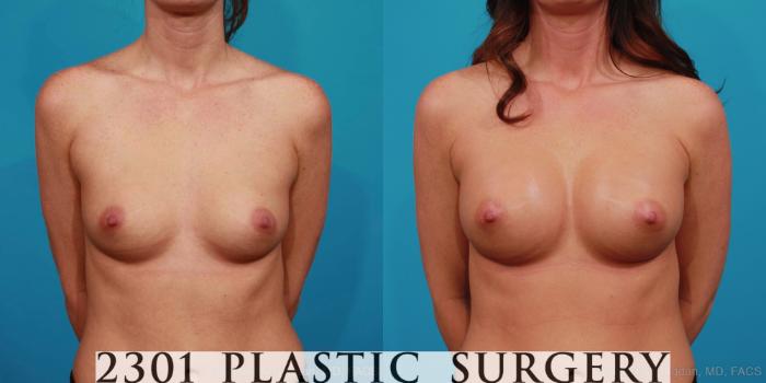 Before & After Silicone Implants Case 345 View #1 View in Fort Worth, Plano, & Frisco, Texas