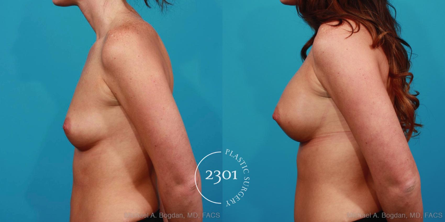 Before & After Silicone Implants Case 345 View #2 View in Fort Worth, Plano, & Frisco, Texas