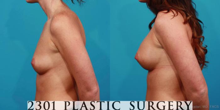 Before & After Silicone Implants Case 345 View #2 View in Fort Worth, Plano, & Frisco, Texas