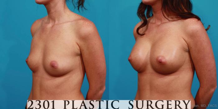 Before & After Silicone Implants Case 345 View #3 View in Fort Worth, Plano, & Frisco, Texas